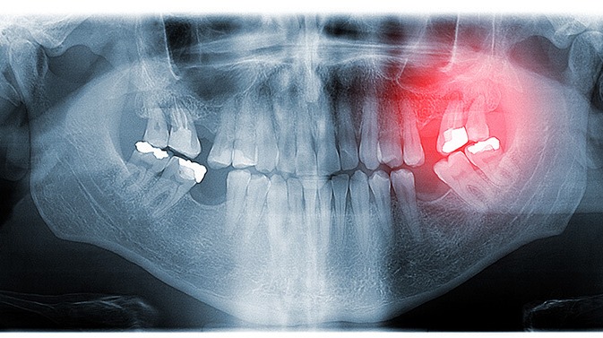 Dental Studio Lalić - Frenektomija